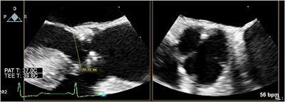 Peri-procedural Trans-esophageal Echocardiographic Sizing of the Native Left Ventricular Outflow Tract During Edwards INTUITY Valve Implantation